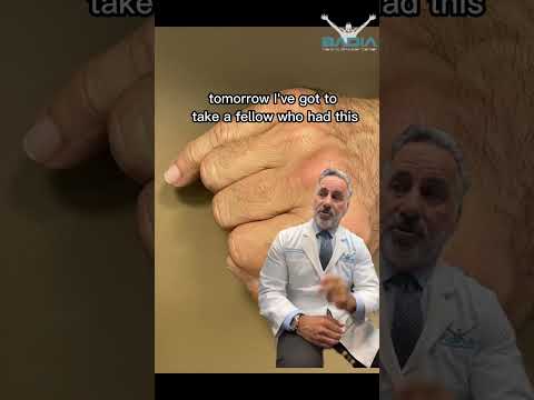 Dr.Badia Explains Finger Fractures & Why they Should be Taken Seriously!