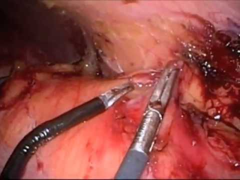 Single Incision Laparoscopic Renal Cryosurgery Video