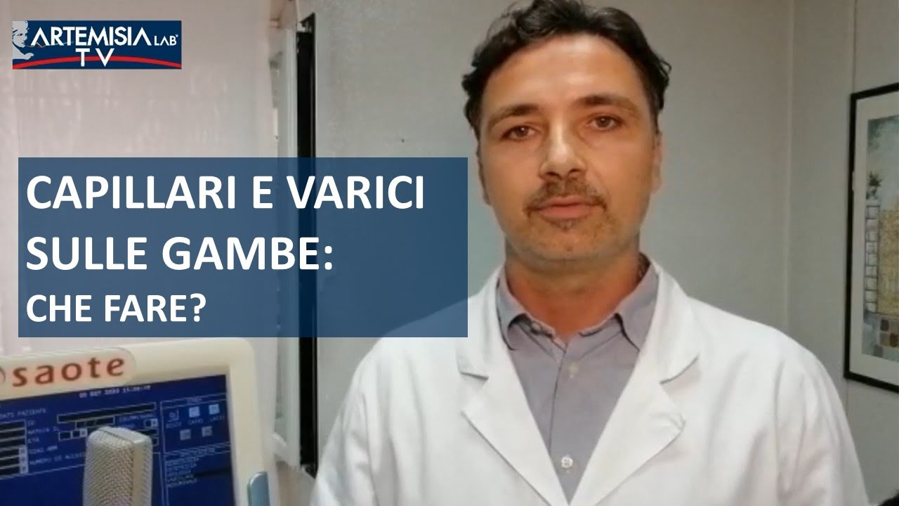 CAPILLARI E VARICI SULLE GAMBE: CHE FARE