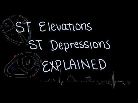 Physiology of ST Segment Elevation and Depression Explained