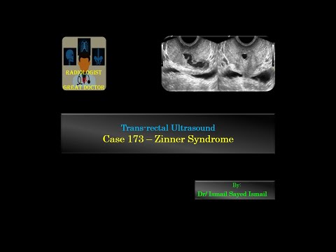 Ultrasound Case 173 - Zinner Syndrome