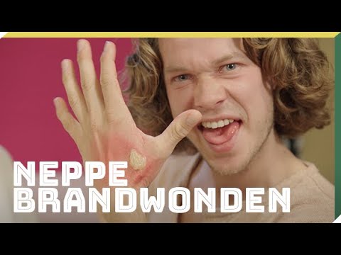 Maak je eigen nep-brandwond | Doe het zelf | Het Klokhuis