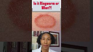 This is  NOT RINGWORM! Ringworm cream won't work! #skincare #skincondition