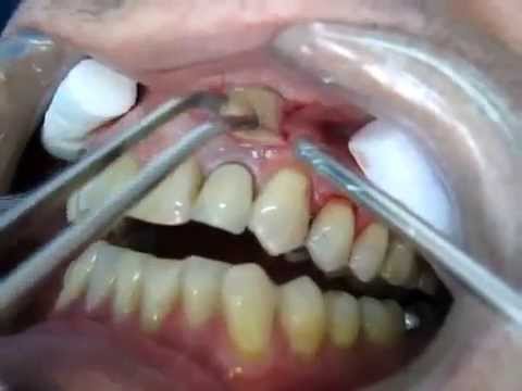comment guerir abces dentaire
