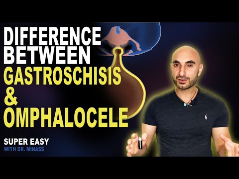 Gastroschisis vs Omphalocele 