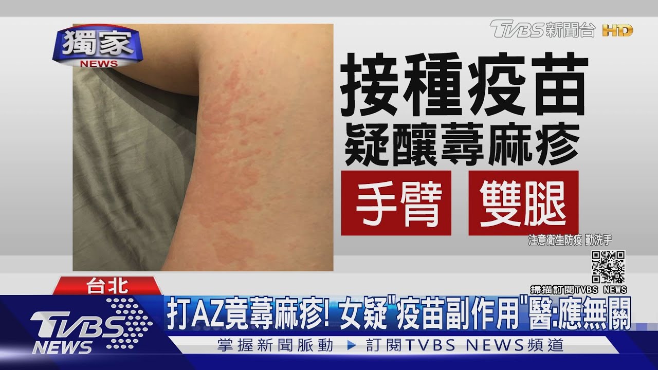 打AZ竟蕁麻疹! 醫師:接種後已達1週應與疫苗無關