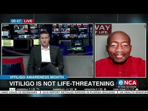 Vitiligo Awareness Month