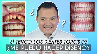 Tengo Los Dientes Torcidos 😬 ¿Me puedo hacer Diseño de Sonrisa 🦷 ¿Me Desgastan - Odontología Láser