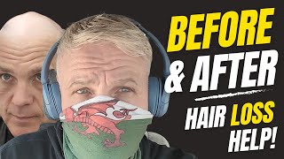 TESTING Hair System In EXTREME WEATHER | Before & After | Hair Loss To Hair In Minutes UK