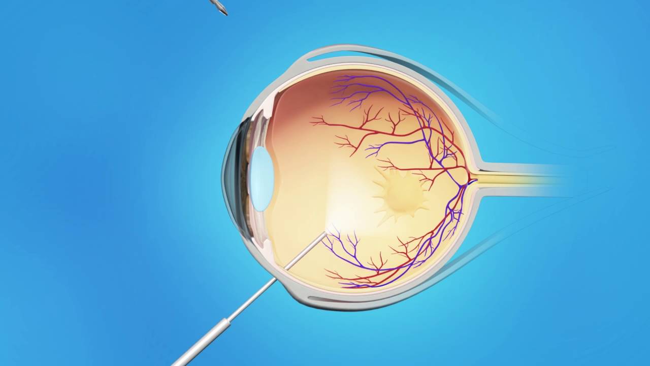 Macular Pucker: Vitrectomy Surgery