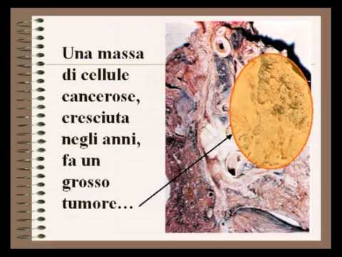 Come liberarsi da pigmentary nota vicino a labbra Violazione di pigmentazione di pelle al bambino