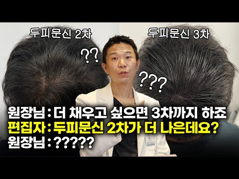 정수리 두피문신 리터치의 중요성 (머리카락 착시효과 보고 가세요)  [ENG JP SUB]