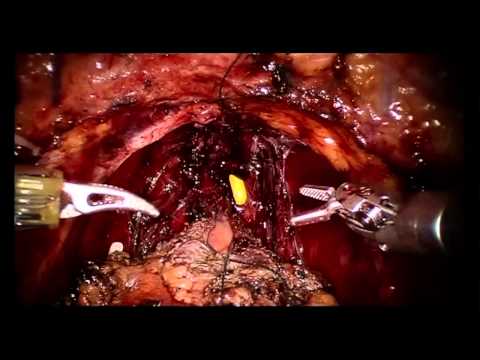Die besten Rezepte der Behandlung von Prostatitis Berdyansk Sanatorium Behandlung von Prostatitis