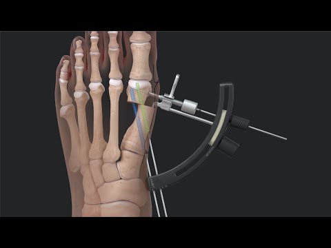 Arthrex Minimally Invasive Bunionectomy System Surgical Technique