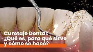 Curetaje Dental: ¿Qué es y cómo se hace