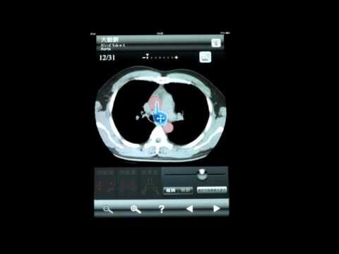 断面図ウォーカー胸部CT Video