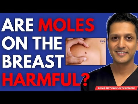 Are Moles On Your Breast Dangerous? (only if they look like this..)