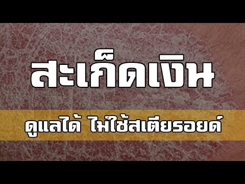 Geptrala แผนกต้อนรับส่วนหน้าในโรคสะเก็ดเงิน อาการกลากของเด็ก