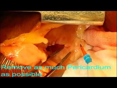 Emergency Pericardiectomy and Pericardiocentesisfor Massive Tubercular Pericardial Effusion