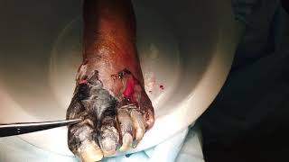 Wet and Dry Gangrene.  What&#39;s the Difference?