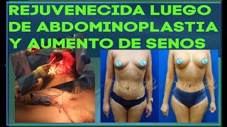 Abdominoplastia y Aumento de Senos | Antes y Después | Dr.Cortes, Houston TX