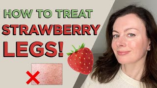 How To Treat Strawberry Legs (and why it happens!) | Dr Sam Bunting