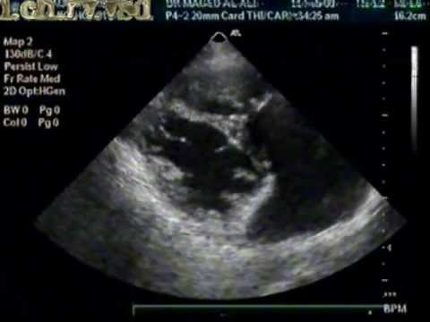 Double-Chambered Right Ventricle (DCRV) And Large Apical Ventricular Septal Defect (VSD)