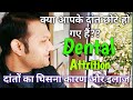 What is Dental Attrition? || दांतों का घिसना कारण और इलाज || Tooth wear || tooth Attrition