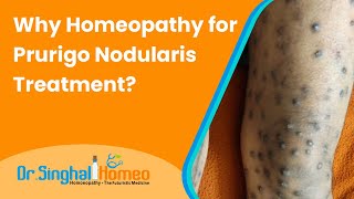 Homeopathic Treatment for Prurigo Nodularis with Effective Results - Dr. Singhal homeo @HomeoDoctor