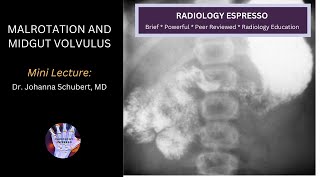 PEDIATRIC MALROTATION AND MIDGUT VOLVULUS: Mini Lecture, Dr. Johanna Schubert, MD