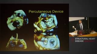 Timing of intervention in mitral regurgitation – Prof Greg Scalia
