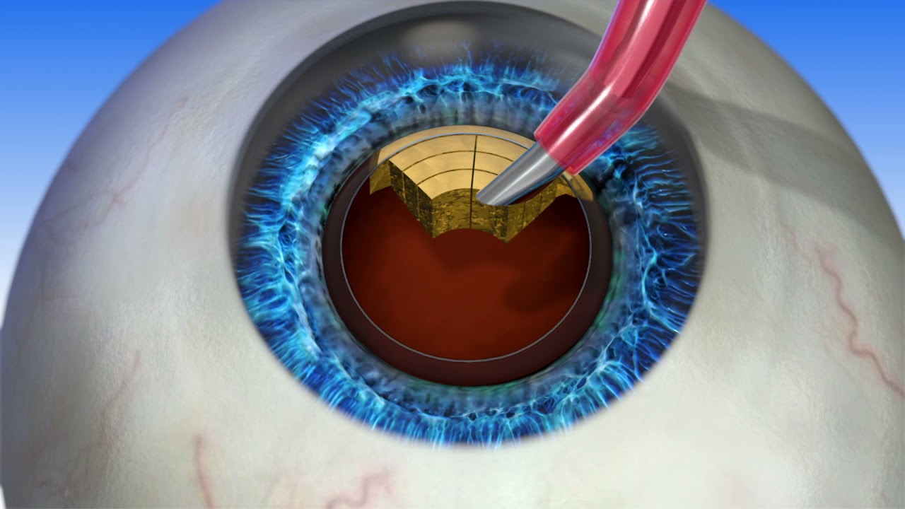 How Cataract Surgery Works