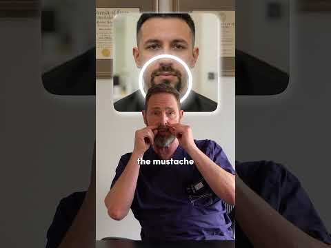 Definitive Overview of the Beard Hair Transplant Procedure in the New York, United States