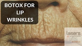 BOTOX for lip wrinkles