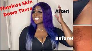 How To Get Rid Of Ingrown Hairs And Dark Spots (Hyperpigmentation) Down There" Fast 100% Works!