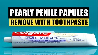 How to Remove (PPP) Pearly Penile Papules using Fluoride Toothpaste