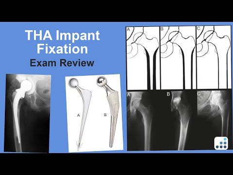 THA Implant Fixation Exam Review - Harry Rubash, MD