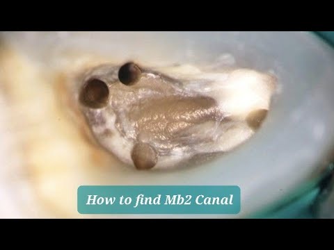 Upper 6 Access Cavity - How to Find MB2 Canal