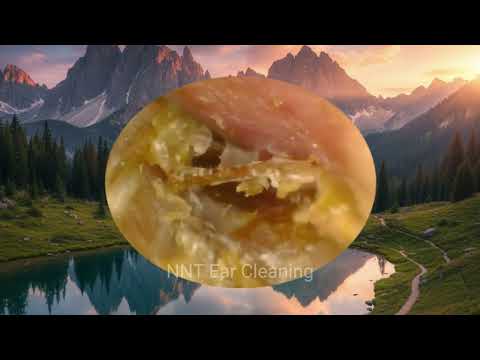 Ear Wax Removal – Years of Blockage Finally Cleared Out! | Deep Ear Cleaning ASMR