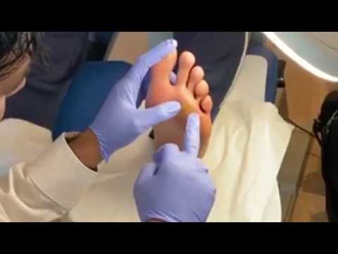 Corn removal with Callus- 1st Time Removal!