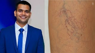 Spider Veins (Varicose veins)  Home Treatment| D.r Vivek