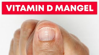 5 Anzeichen eines akuten Vitamin-D-Mangels!