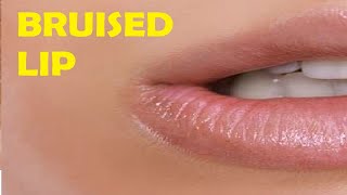 how to get rid of a bruise on your lip in only 3 minutes