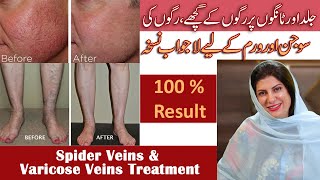 GET RID OF SPIDER VEINS & VARICOSE VEINS ON FACE & LEGS | HOMEMADE TREATMENT BY DR. BILQUIS IN URDU