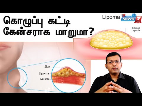 கொழுப்பு கட்டி cancer கட்டியா மாறுமா | kolupu katti | lipoma | Dr.Arun kumar Explains
