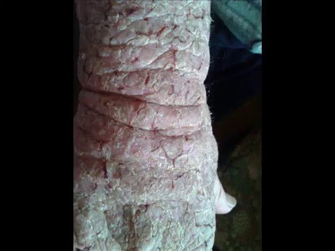 Come liberarsi da eczema sulla testa Psoriasi su un gomito a bambini