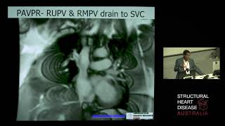 Interesting MRI Cases of the Right Heart – Dr Raj Puranik