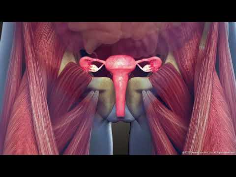 What is Intramural Uterine Fibroid: Symptoms and Treatment | 3D Guide