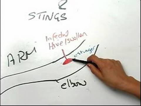 How to Treat Insect Bites & Stings : How to Treat a Bee Sting