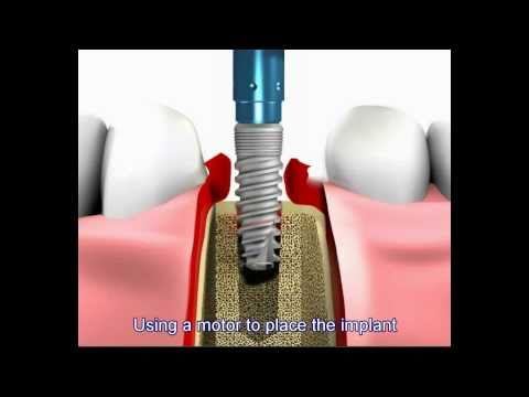 Dental implant procedure